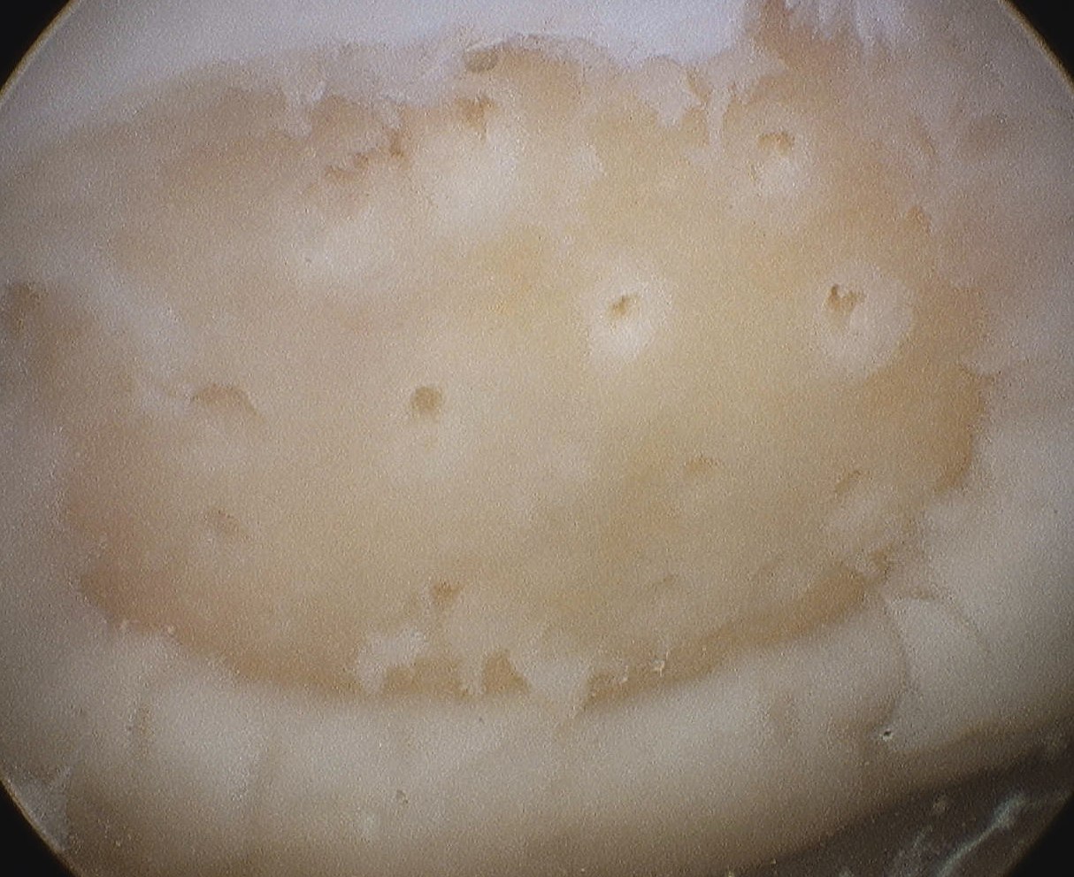 Microfracture Awl Holes